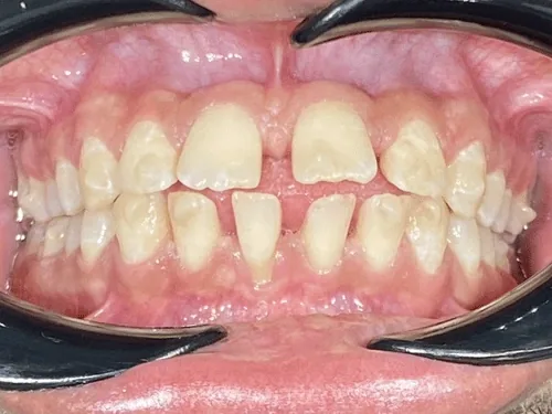 Teeth before Sebaris aligners