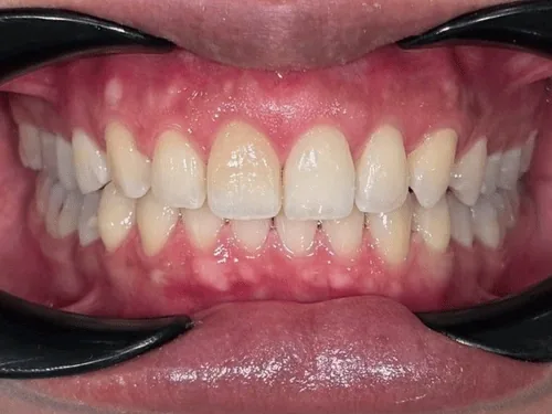 Teeth after Sebaris aligners